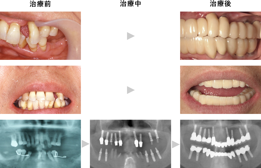 全体的なインプラント埋入治療