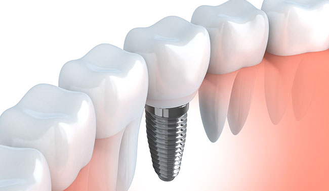 インプラント埋入治療とは